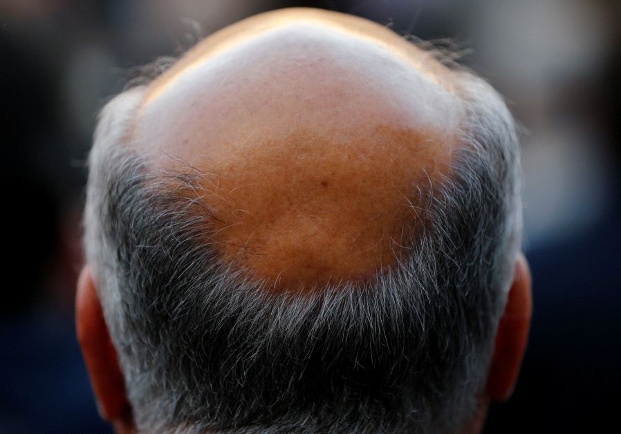 A man with baldness is seen in Seville, southern Spain
