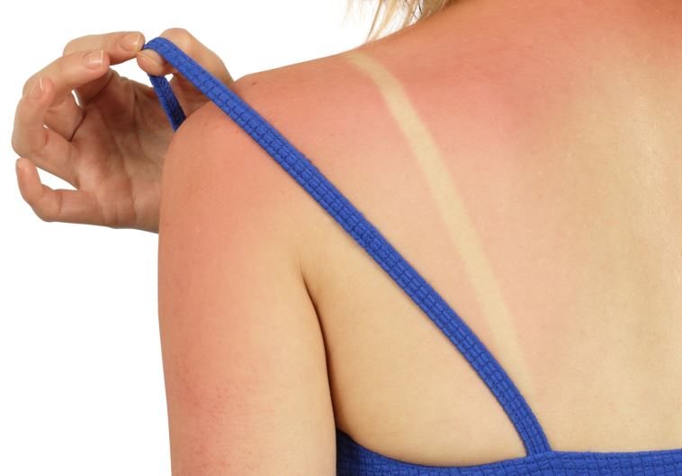 Woman with sunburn (illustrative).