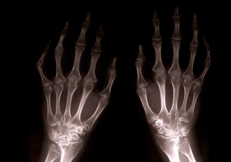 Close up of xray hands